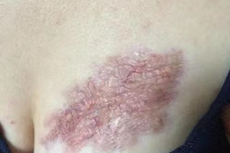 瘢痕疙瘩乳房瘢痕图 瘢痕疙瘩乳房瘢痕图