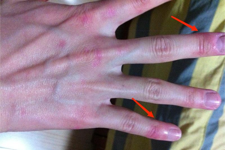 硬红斑手指尖症状图