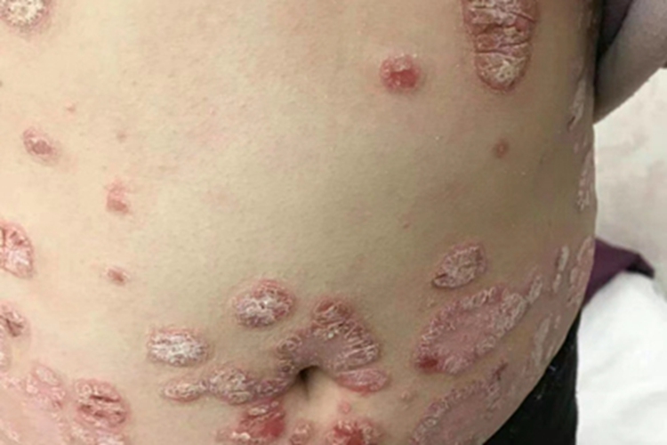 寻常型银屑病腹部红斑图 寻常型银屑病腹部红斑图