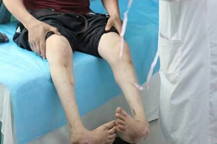 先天性马蹄内翻足脚部畸形图