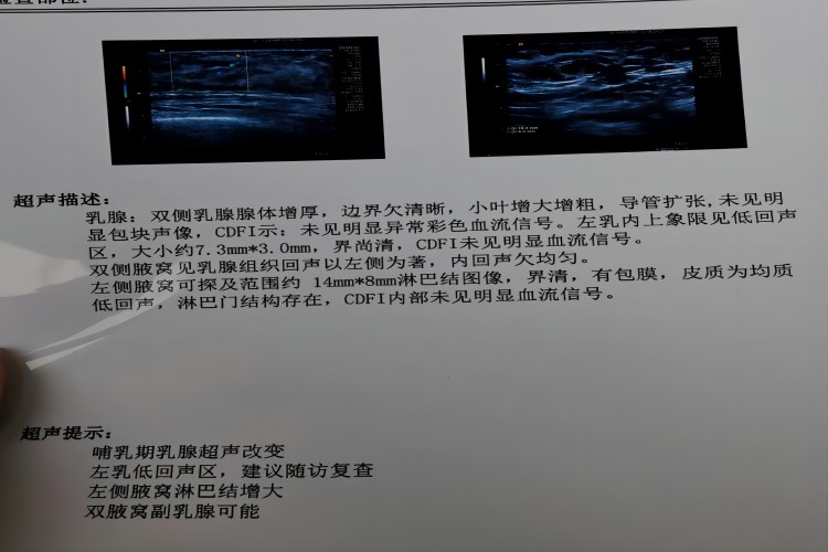 急性乳腺炎B超报告单图