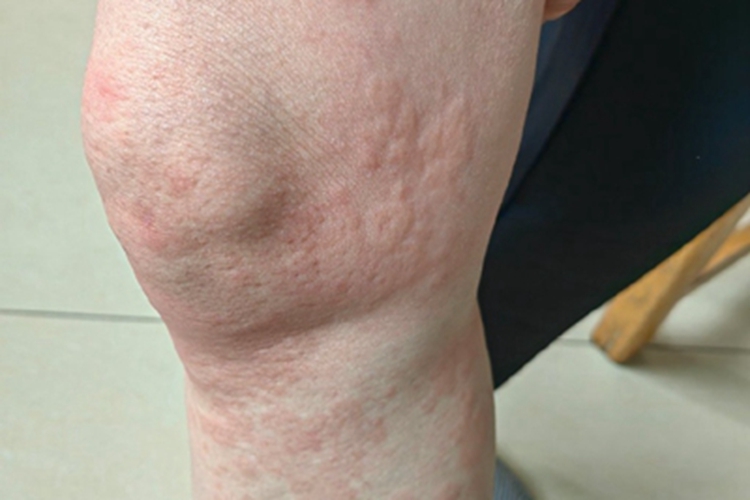 荨麻疹型药疹丘疹图 荨麻疹型药疹丘疹图