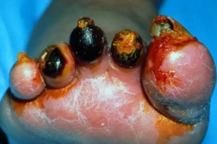 湿性坏疽脚趾皮肤发黑图 湿性坏疽脚趾皮肤发黑图