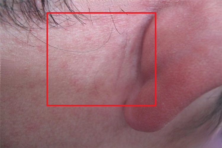 风疹耳后丘疹图