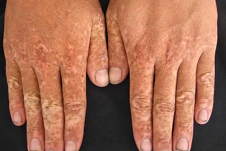 先天性角化不良手背症状图
