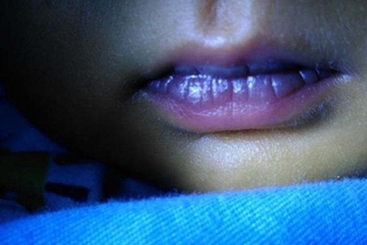 冷凝集素综合征嘴唇皮肤发紫图