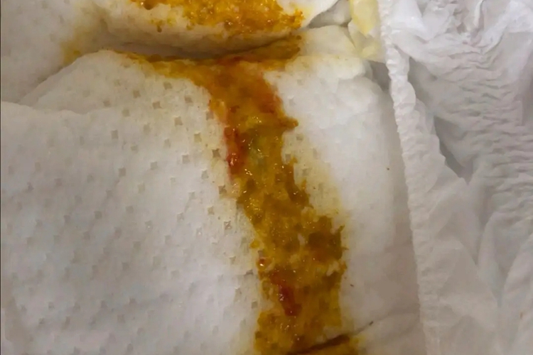 溃疡性结肠炎黏液脓血便图