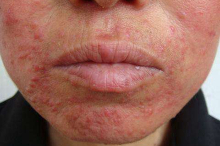 颜面粟粒性狼疮症状图