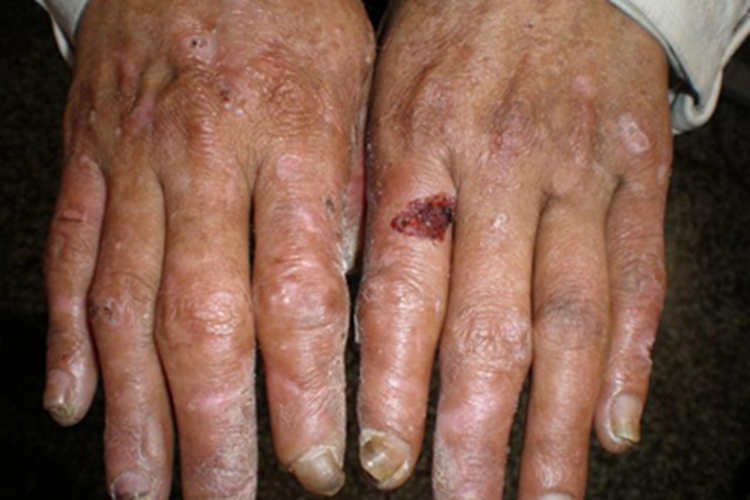 假性卟啉病手指红斑图 假性卟啉病手指红斑图