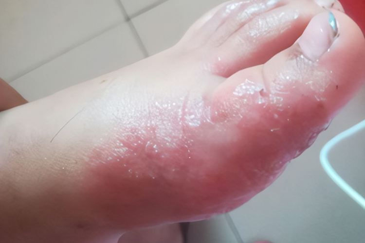 小孩脚上湿疹图
