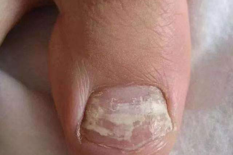 脚趾白色浅表型甲癣图