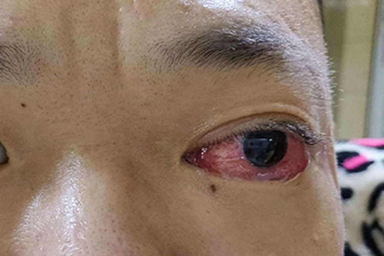 罗阿丝虫病结膜充血图