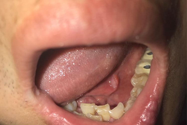 表皮样囊肿白色疙瘩图