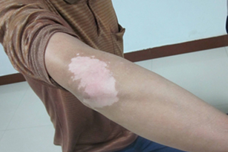 非节段型白癜风肘部白斑图