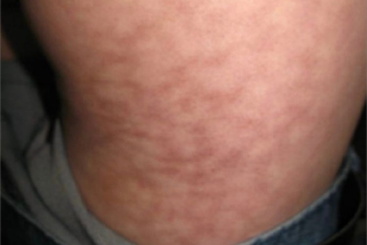 热激红斑腰部红斑图