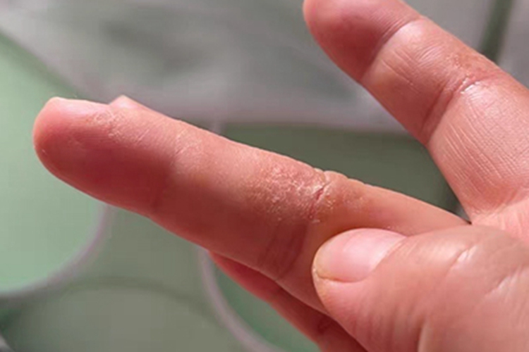 汗疱疹手指干燥脱皮图 汗疱疹手指干燥脱皮图