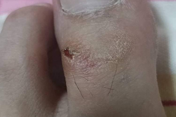 亚急性湿疹皮肤增厚图