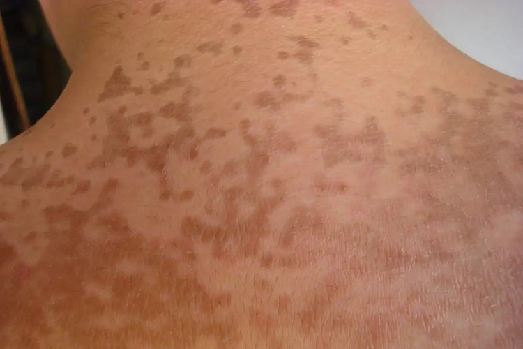 融合性网状乳头瘤病图