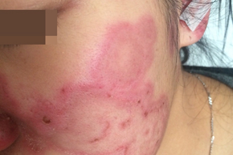 离心性环状红斑面部症状图 离心性环状红斑面部症状图