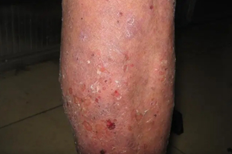 全身性瘙痒症小腿血痂图