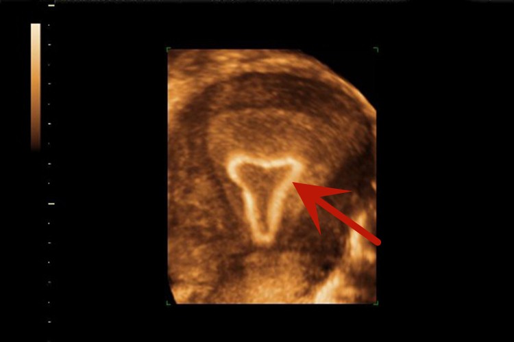 彩超显示曼月乐环下移图