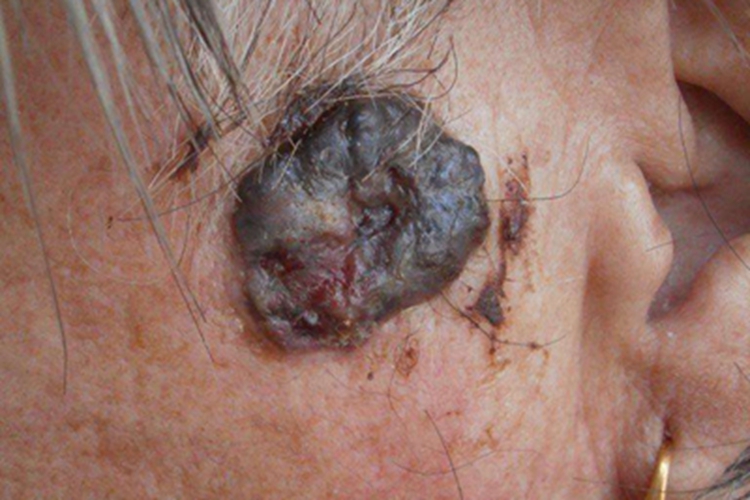 色素型基底细胞癌面部结节图