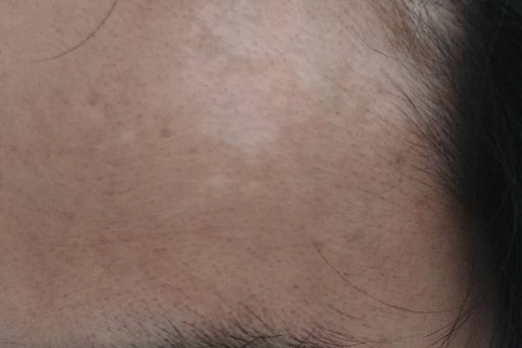 白癜风前额皮肤颜色变浅图