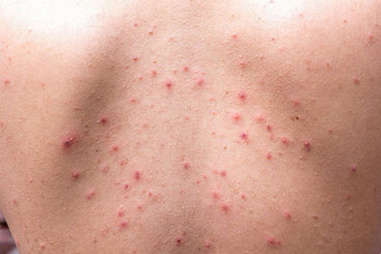 寻常性痤疮暗红色结节图