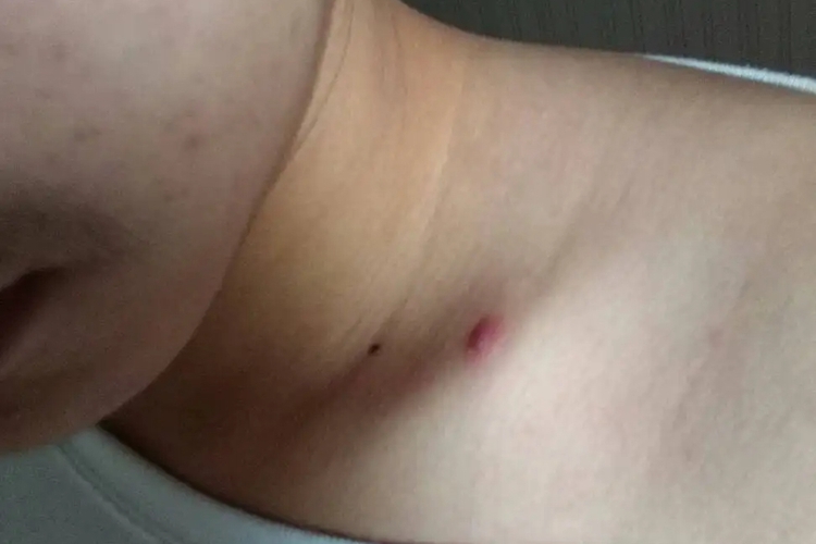 锁骨疖疙瘩图 锁骨疖疙瘩图