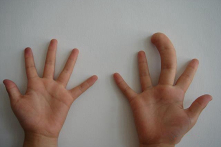 巨指畸形中指粗大弯曲图 巨指畸形中指粗大弯曲图