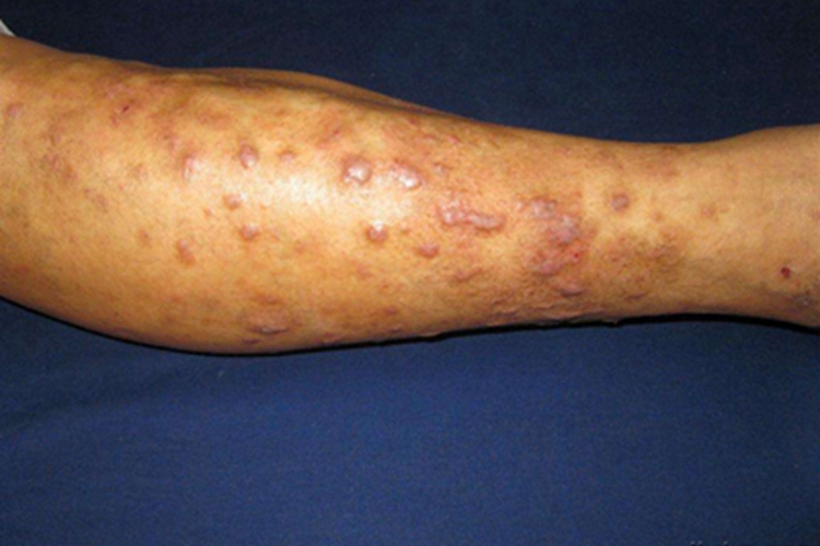 血吸虫尾蚴皮炎小腿症状图 血吸虫尾蚴皮炎小腿症状图