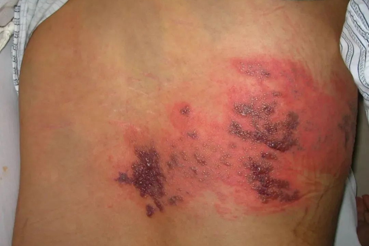 带状疱疹后期干燥结痂图