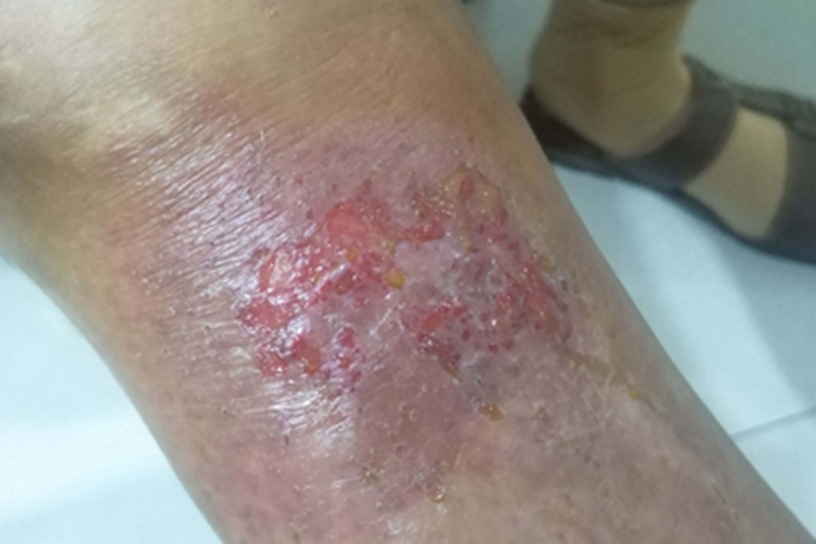 急性湿疹胳膊皮肤颜色加深图 急性湿疹胳膊皮肤颜色加深图