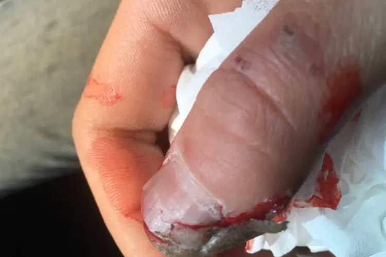 拳击手骨折图 拳击手骨折图