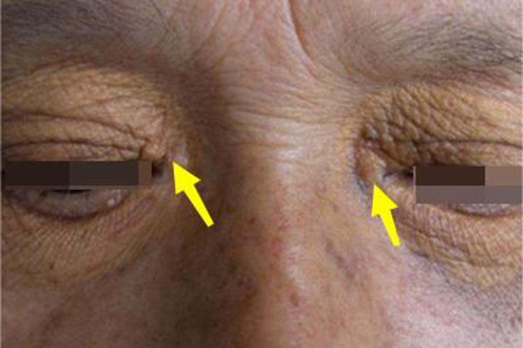 发疹性黄瘤眼周症状图 发疹性黄瘤眼周症状图
