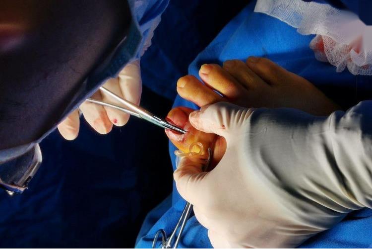 甲沟炎手术脓肿切开图