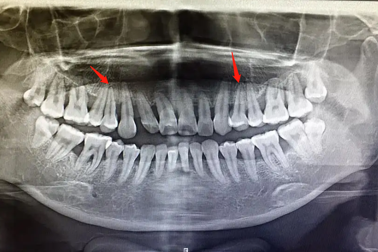 牙槽骨吸收轻度影像图 牙槽骨吸收轻度影像图