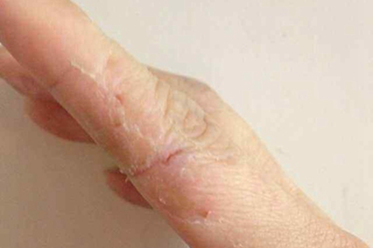亚急性湿疹手指裂纹图