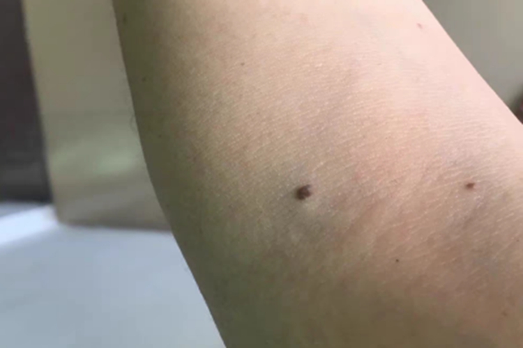 交界痣胳膊小疙瘩图