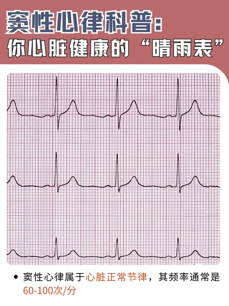 窦性心律科普：你心脏健康的“晴雨表”