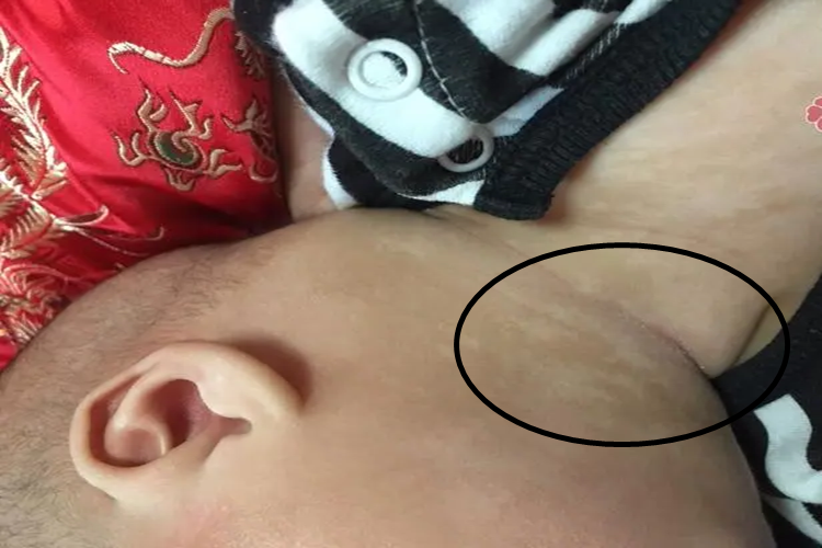 婴儿颈部白色胎记图 婴儿颈部白色胎记图