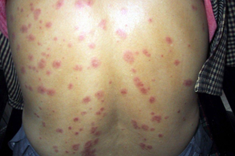 多形红斑背部症状图 多形红斑背部症状图