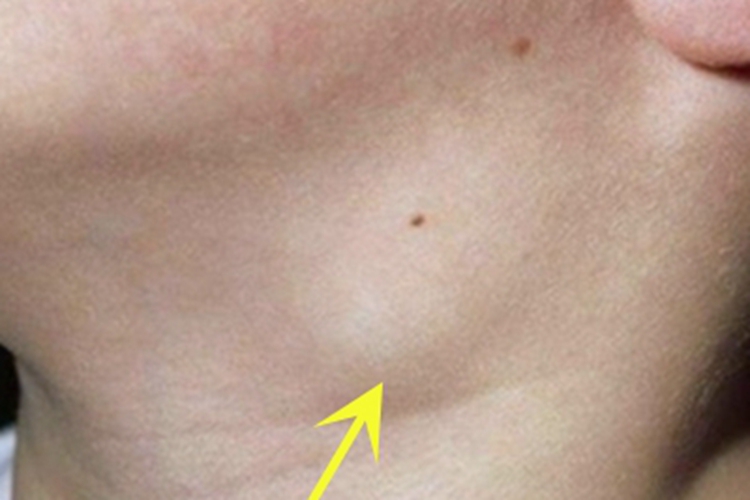 男性一期梅毒症状图 男性一期梅毒症状图