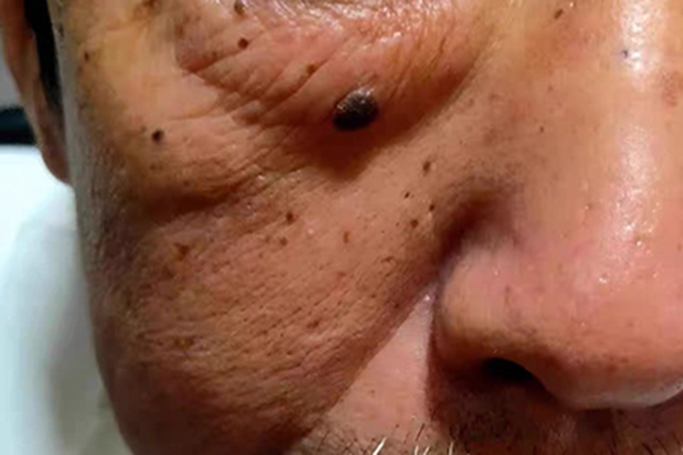 复合痣面部肉球图