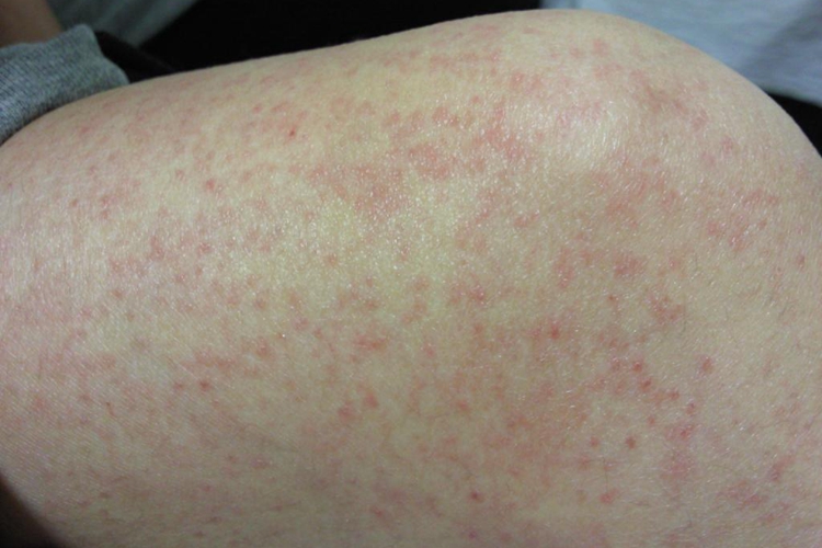 膝盖附近湿疹图