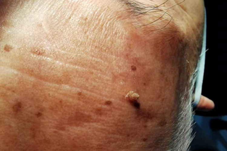 寻常疣前额症状图 寻常疣前额症状图