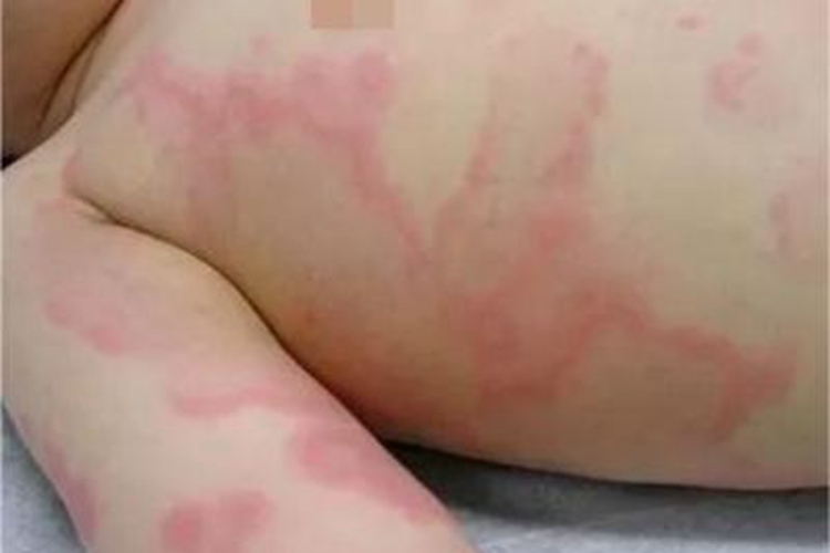 荨麻疹型药疹肋部症状图 荨麻疹型药疹肋部症状图