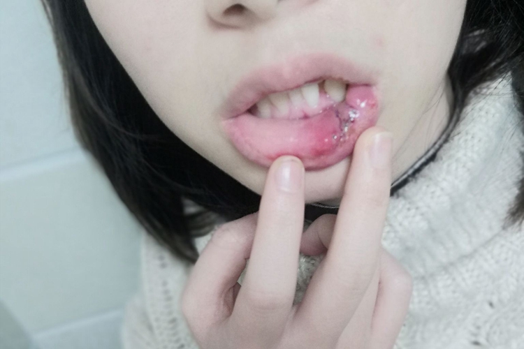 嘴唇囊肿术后黏膜蜈蚣状缝合图