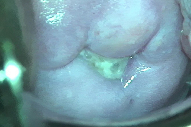 急性宫颈炎分泌物图