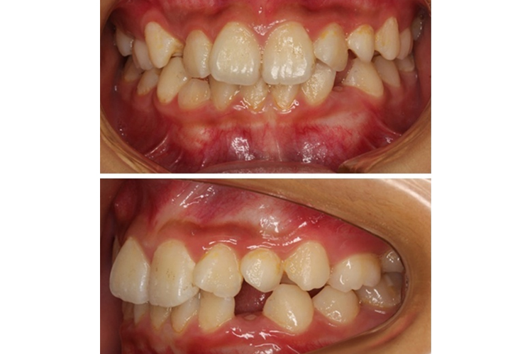 上颌牙唇倾度正常图